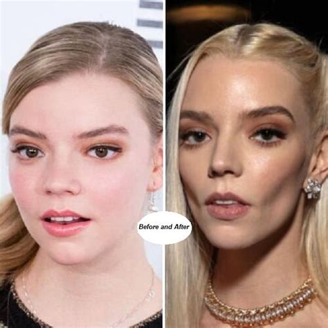 anya taylor-joy surgery|Anya Taylor